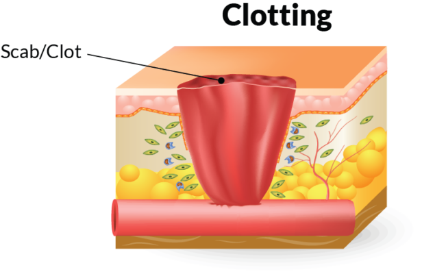 Stages Of Wound Healing | Home Care Delivered