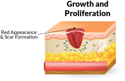 Stages Of Wound Healing | Home Care Delivered